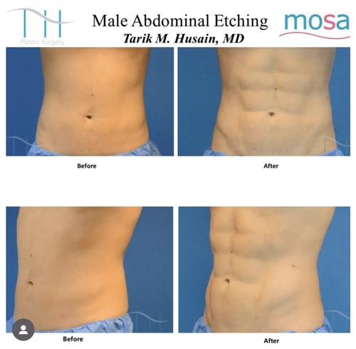 Abdominal Etching Male Gallery at Advanced Aesthetic Wellness in Miami Beach, FL