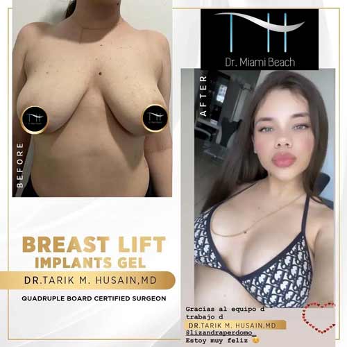Breast Augmentation Gallery at Advanced Aesthetic Wellness in Miami Beach, FL