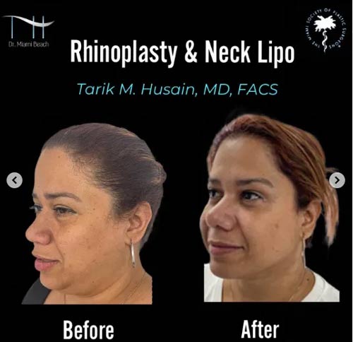 Neck & Face Lift Gallery at Advanced Aesthetic Wellness in Miami Beach, FL