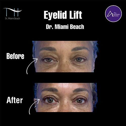 Neck & Face Lift Gallery at Advanced Aesthetic Wellness in Miami Beach, FL