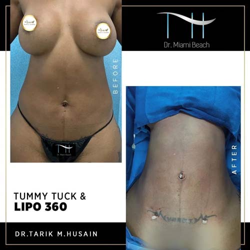 Liposuction Gallery at Advanced Aesthetic Wellness in Miami Beach, FL