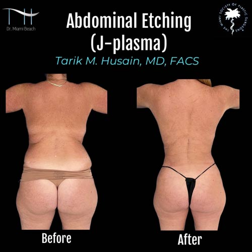 Liposuction Gallery at Advanced Aesthetic Wellness in Miami Beach, FL