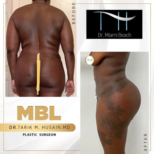Miami Butt Lift Gallery at Advanced Aesthetic Wellness in Miami Beach, FL