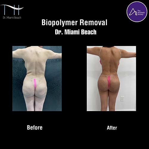 Miami Butt Lift Gallery at Advanced Aesthetic Wellness in Miami Beach, FL