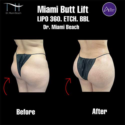 Miami Butt Lift Gallery at Advanced Aesthetic Wellness in Miami Beach, FL